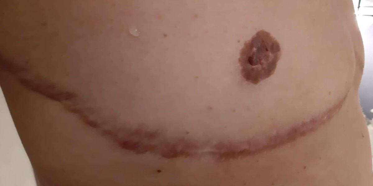 เทคนิกหารผ่าตัดหน้าอก และความรู้สึกเสียวที่หัวนม